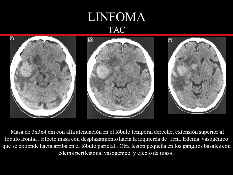 Tumor del lóbulo frontal Tumor del lóbulo frontal